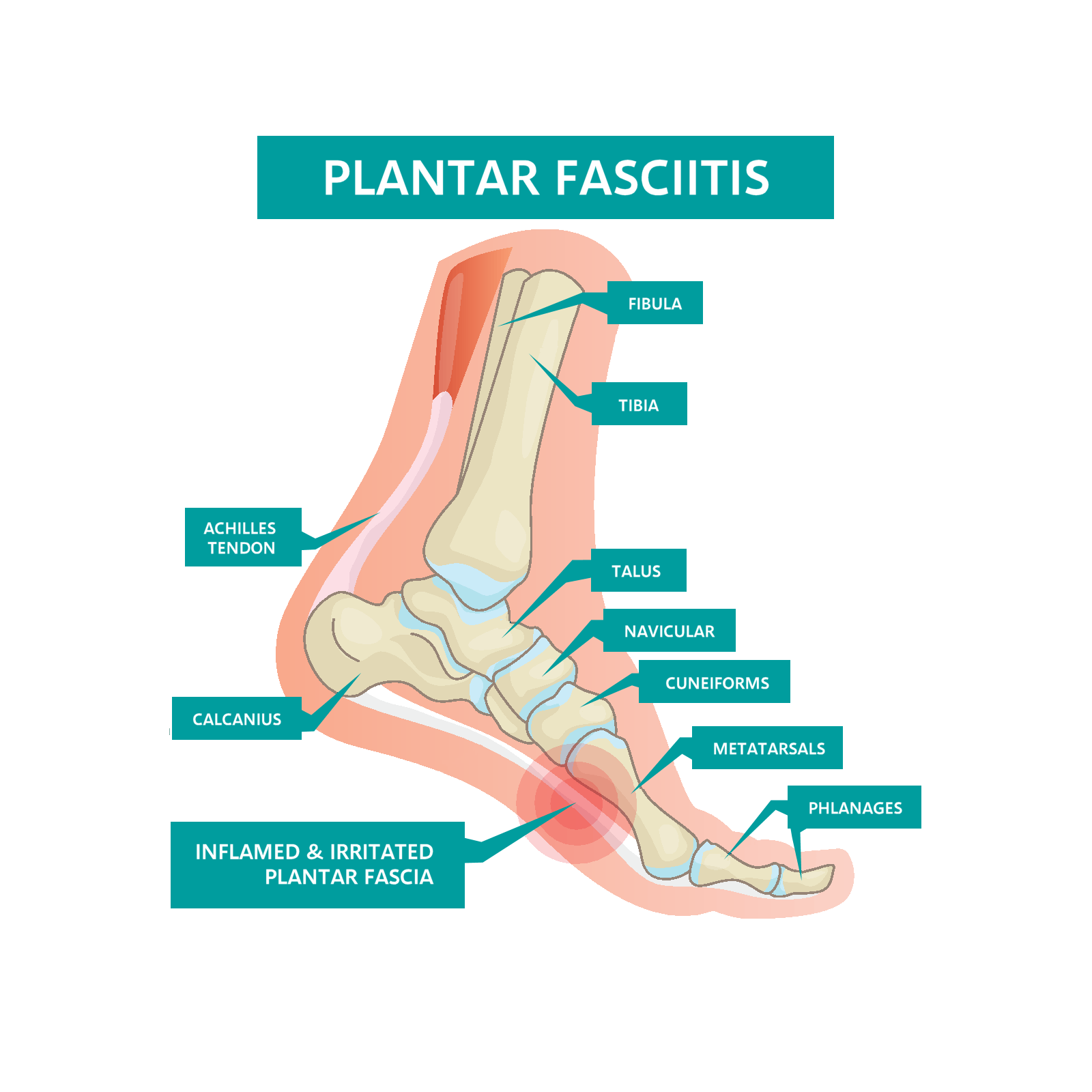 plantar-fasciitis - causes and symptoms