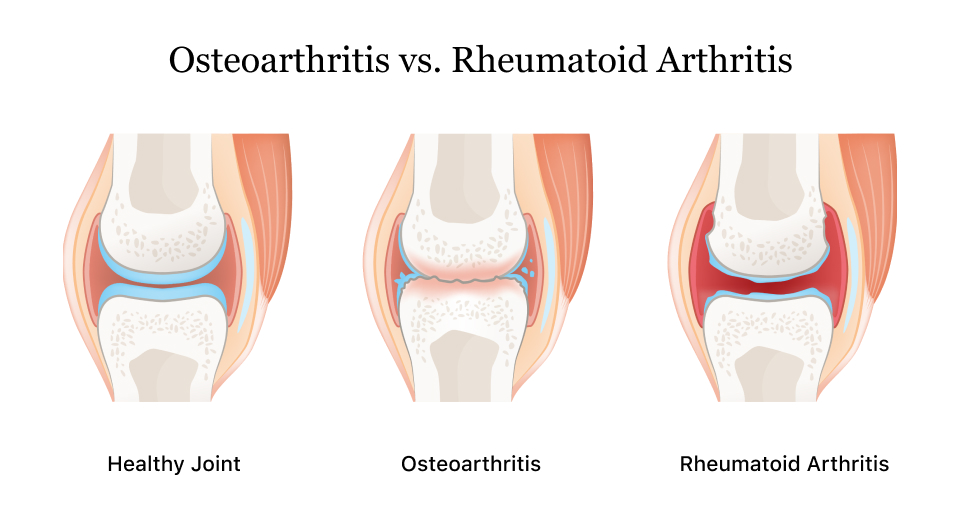 Arthritis | A Guide to the Symptoms, Causes & Types of Arthritis